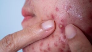 Beyaz sivilceleri 15 günde kurutuyor! Kremlere son, iltihaplı sivilcelerden kurtarıyor