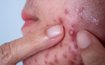 Beyaz sivilceleri 15 günde kurutuyor! Kremlere son, iltihaplı sivilcelerden kurtarıyor