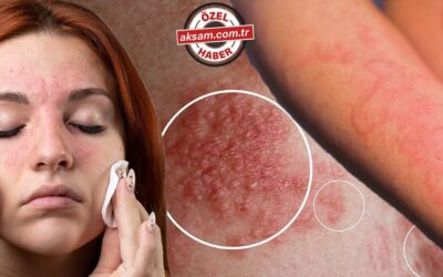 Ürtiker cilt kanserine dönüşür mü? Uzmanı açıkladı: Kaşıntıyla başlıyor! Dudakta, gözde ve boğazda şişlik yapıyor