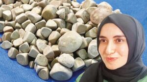 Vücudundan 287 taş çıkartıldı! "Çok nadir bir olay"